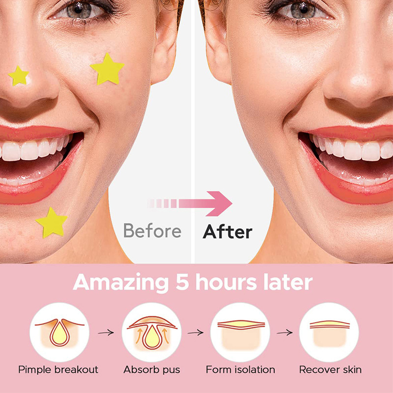 600 PCS/Set Star Pimple Patch  - Beauty Makeup Remover ulasan dan harga